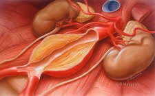Abdominal Aortic Aneurysm
