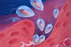Trichomoniasis