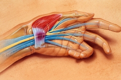 Carpal Tunnel Syndrome