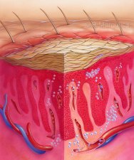 Psoriasis