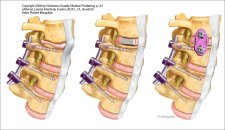 Spine Surgery